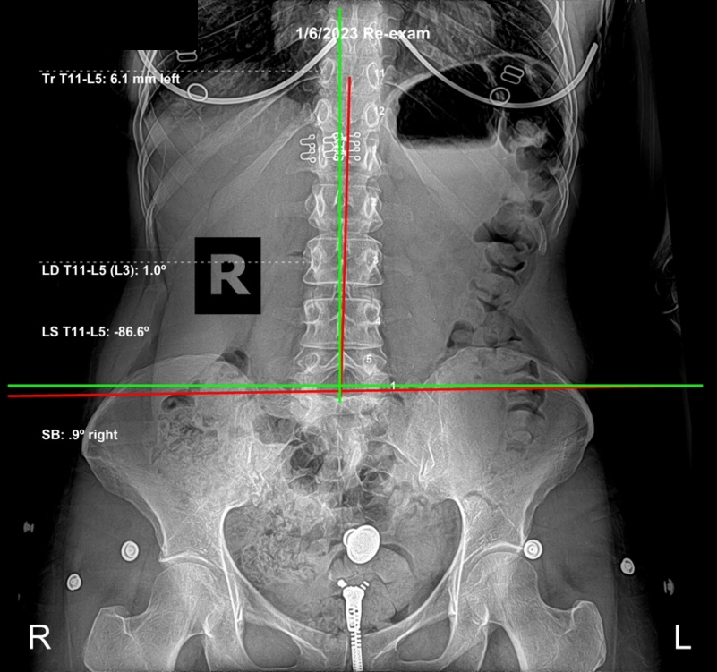January 6, 2023 re-evaluation AP lumbar X-ray showing significant correction of the spine back toward vertical after six months of corrective care, Rochet Family Chiropractic Royal Palm Beach