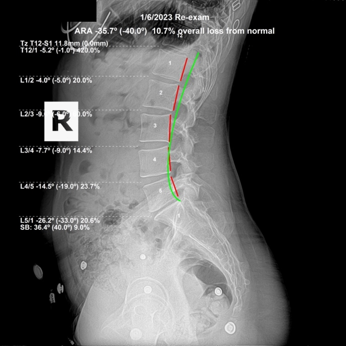 January 6, 2023 re-evaluation lateral lumbar X-ray showing drastically improved lumbar lordosis and more than ten percent increase in L5 disc size, Rochet Family Chiropractic Royal Palm Beach