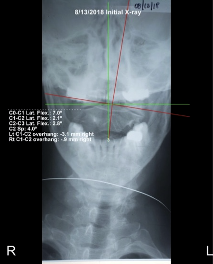 Initial upper cervical AP X-ray August 2018 — atlas and axis misalignment, head position severely deviated, Rochet Family Chiropractic Royal Palm Beach