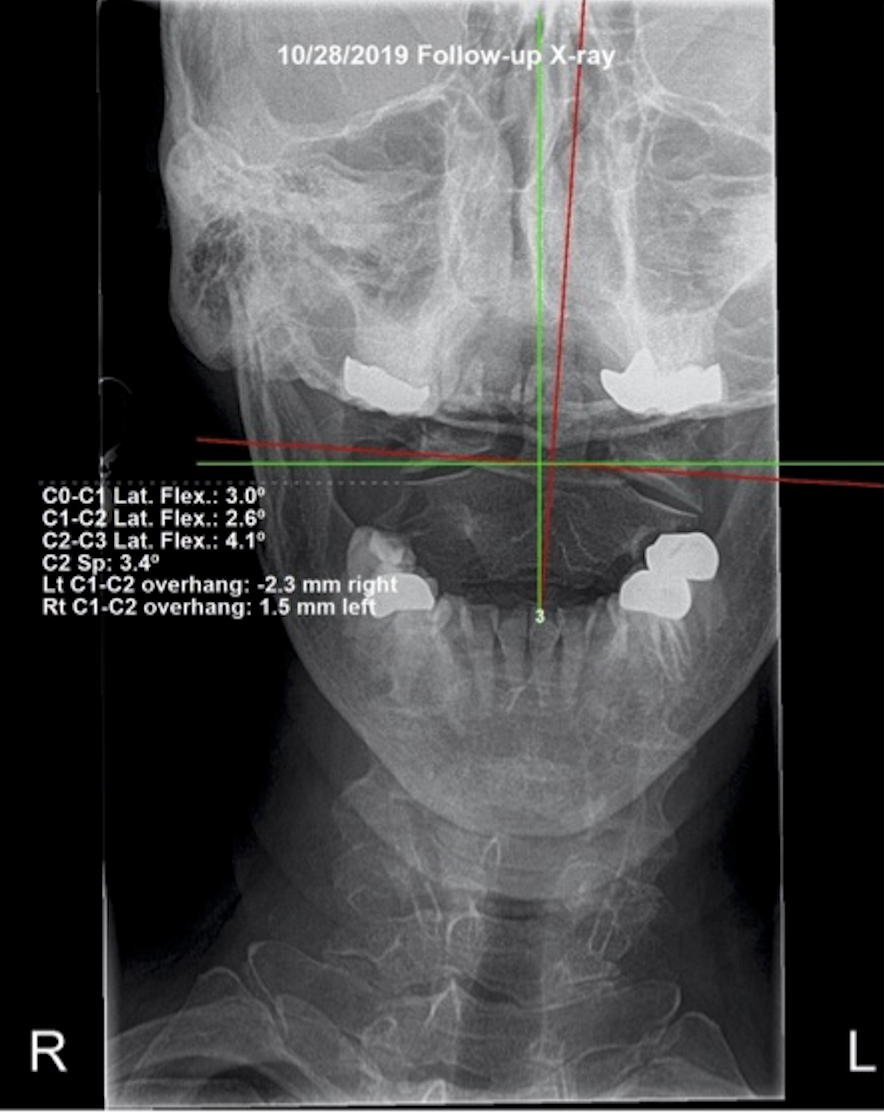 Follow-up upper cervical AP X-ray October 2019 — marked improvement in head position and upper cervical alignment, Rochet Family Chiropractic Royal Palm Beach