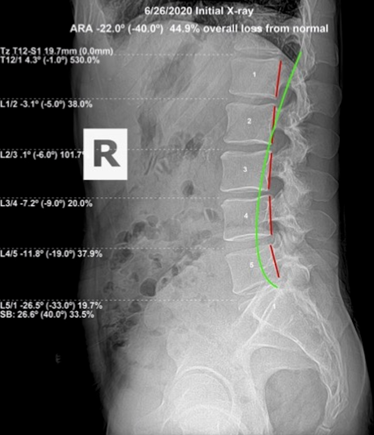 June 26, 2020 initial lateral lumbar X-ray showing ARA -22.0 degrees against -40.0 normal, 44.9 percent overall loss from normal in 48-year-old HVAC tradesman with acute work injury, Rochet Family Chiropractic Royal Palm Beach