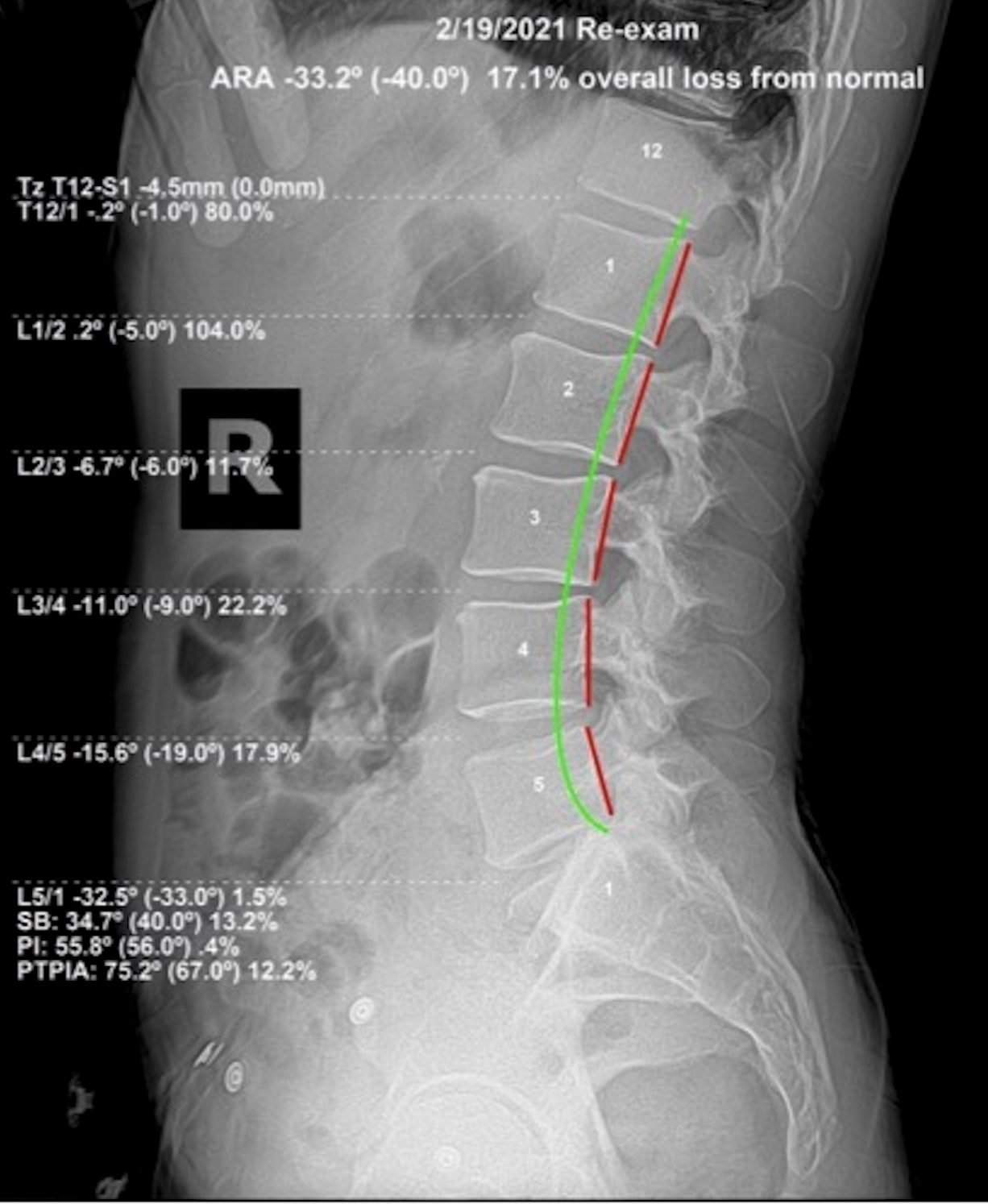 Re-evaluation lateral lumbar X-ray showing ARA -33.2 degrees against -40.0 normal, 17.1 percent overall loss from normal after 6 months of corrective care, Rochet Family Chiropractic Royal Palm Beach