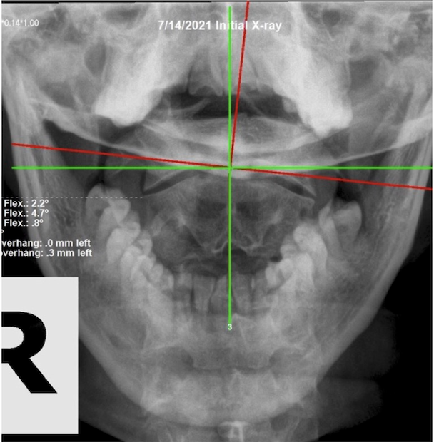 July 14, 2021 initial APOM open-mouth upper cervical X-ray of a 45-year-old female nail technician showing upper cervical subluxation, Rochet Family Chiropractic Royal Palm Beach