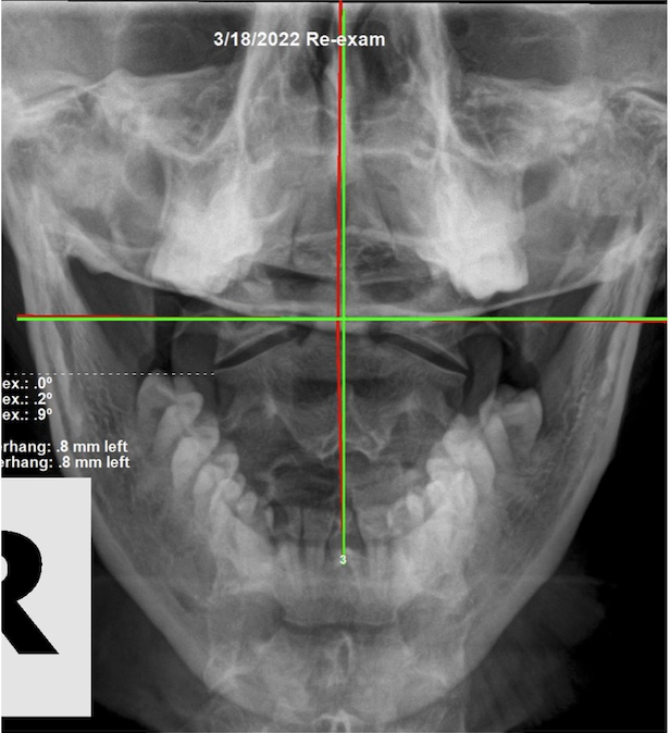 March 18, 2022 re-evaluation APOM open-mouth upper cervical X-ray showing corrected upper cervical alignment after subluxation-based corrective care, Rochet Family Chiropractic Royal Palm Beach