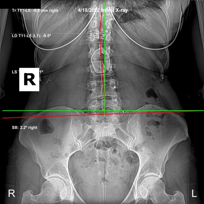 April 18, 2022 initial AP lumbar X-ray showing an AI sacrum and significant subluxation deformity at L1 in a 49-year-old female, Rochet Family Chiropractic Royal Palm Beach