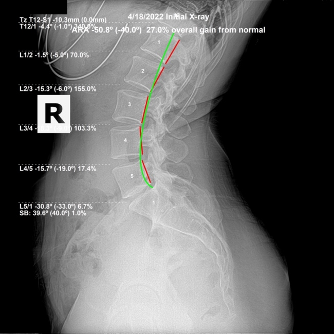 April 18, 2022 initial lateral lumbar X-ray showing increased lumbar curvature and a degenerated L5 disc, Rochet Family Chiropractic Royal Palm Beach