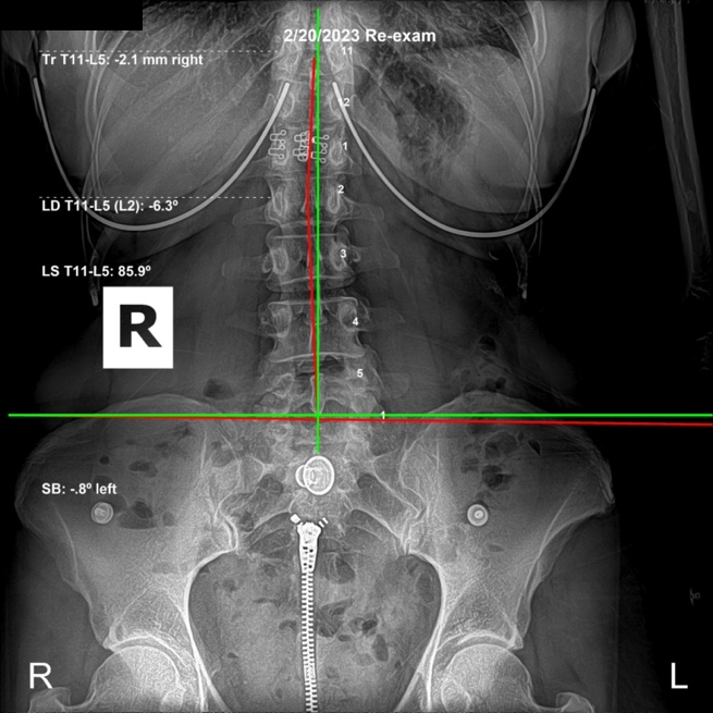 February 20, 2023 re-evaluation AP lumbar X-ray showing the AI sacrum corrected and the pelvis leveled, Rochet Family Chiropractic Royal Palm Beach