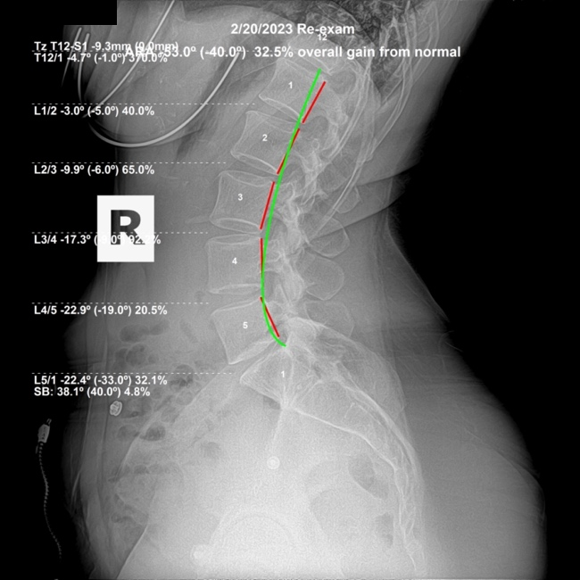 February 20, 2023 re-evaluation lateral lumbar X-ray showing improved lumbar lordosis and a reduced L1 L2 subluxation, Rochet Family Chiropractic Royal Palm Beach