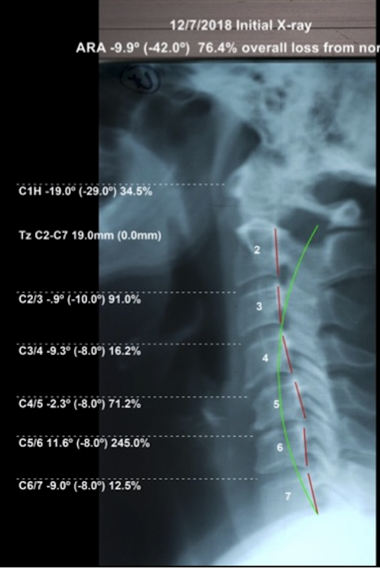 Initial lateral cervical X-ray December 2018 — ARA -9.9 degrees, 76.4% overall cervical curve loss, reversed curve with bone destruction and disc loss, Rochet Family Chiropractic Royal Palm Beach