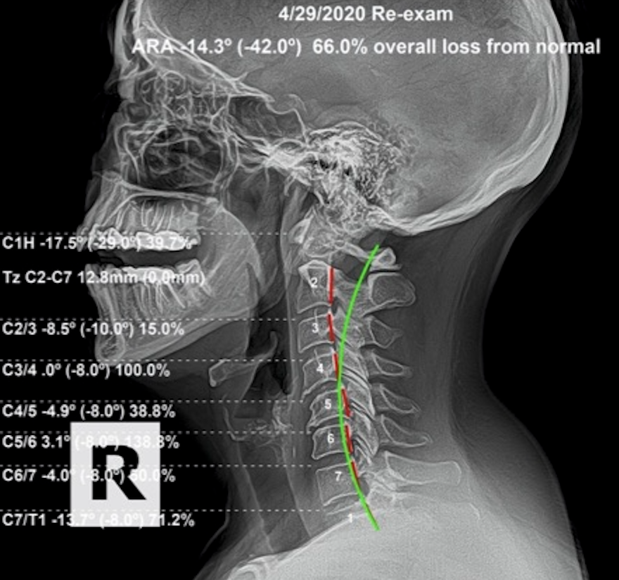 Re-evaluation lateral cervical X-ray April 2020 — ARA -14.3 degrees, 66.0% overall loss, cervical curve reversing back toward normal, Rochet Family Chiropractic Royal Palm Beach