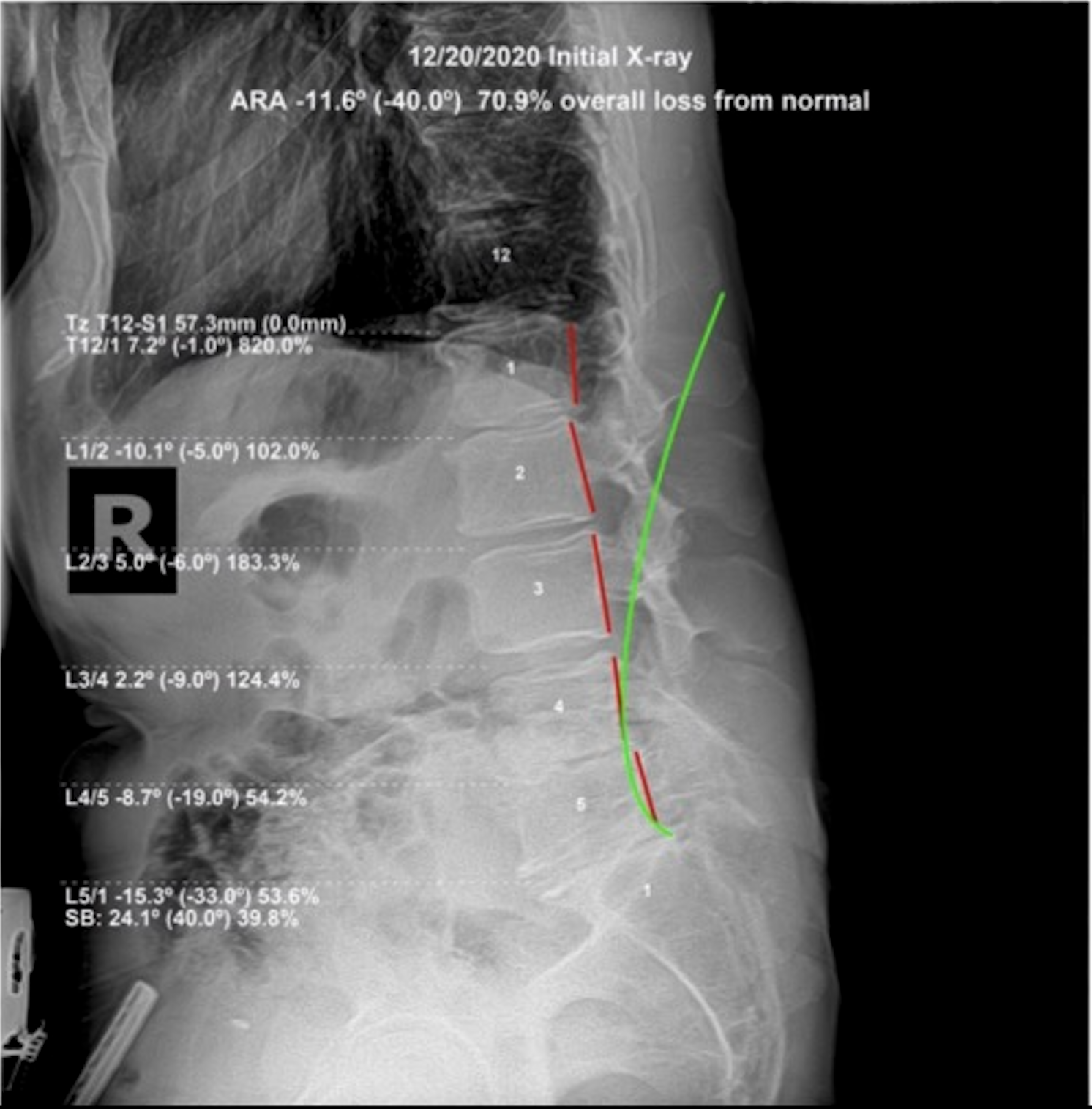 December 20, 2020 initial lateral lumbar X-ray showing ARA -11.6 degrees against -40.0 normal, 70.9 percent overall loss from normal in 66-year-old athlete with spondylosis and disc degeneration, Rochet Family Chiropractic Royal Palm Beach