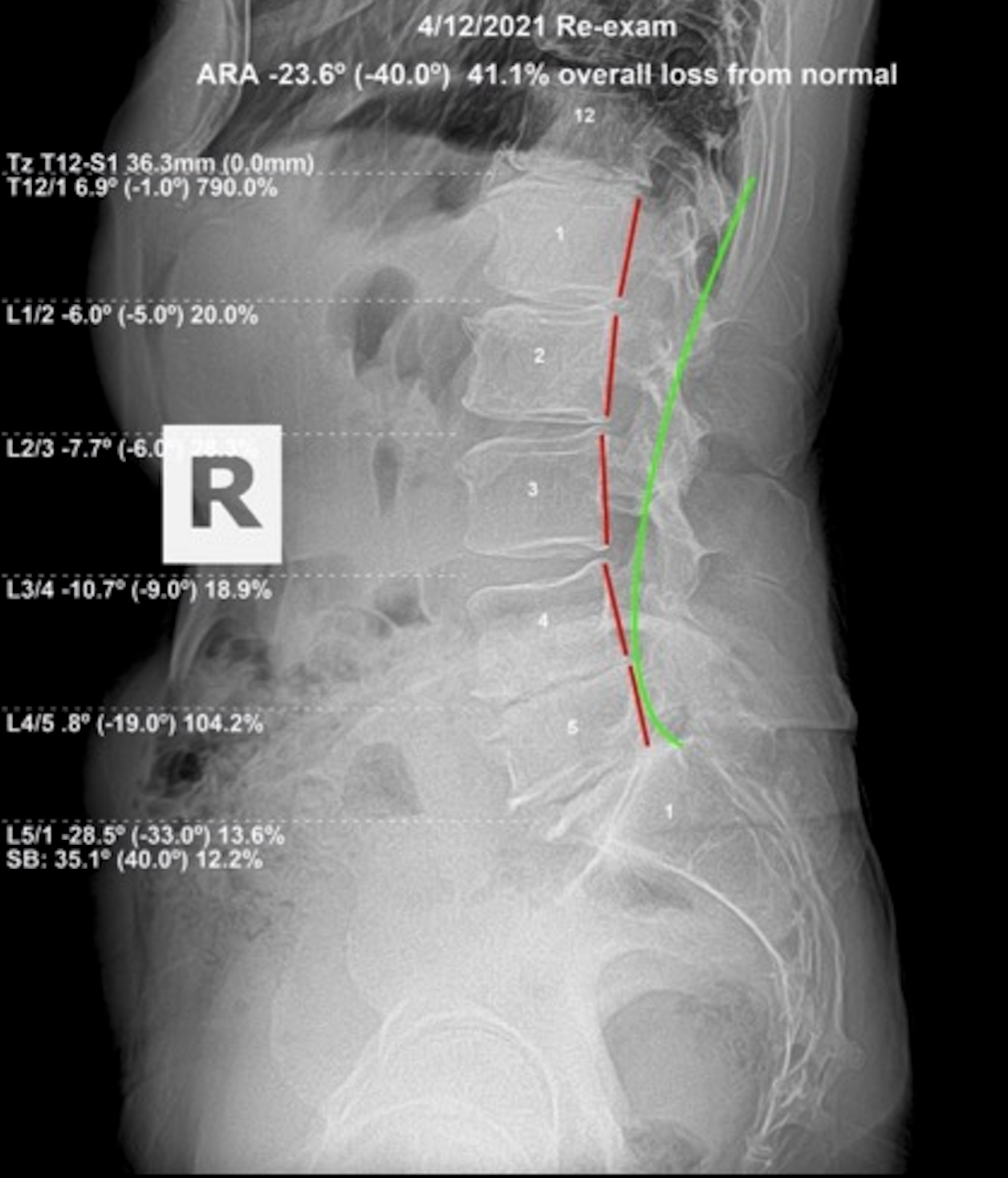 April 12, 2021 re-evaluation lateral lumbar X-ray showing ARA -23.6 degrees against -40.0 normal, 41.1 percent overall loss from normal after 5 months of subluxation-focused corrective care, Rochet Family Chiropractic Royal Palm Beach