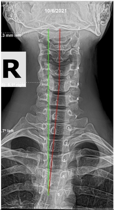 October 6, 2021 initial AP cervical X-ray of a 24-year-old male showing cervical subluxation and lateral neck deviation, Rochet Family Chiropractic Royal Palm Beach