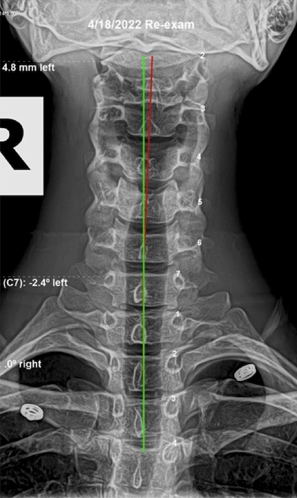 April 18, 2022 re-evaluation AP cervical X-ray showing improved cervical alignment after subluxation-based corrective care, Rochet Family Chiropractic Royal Palm Beach