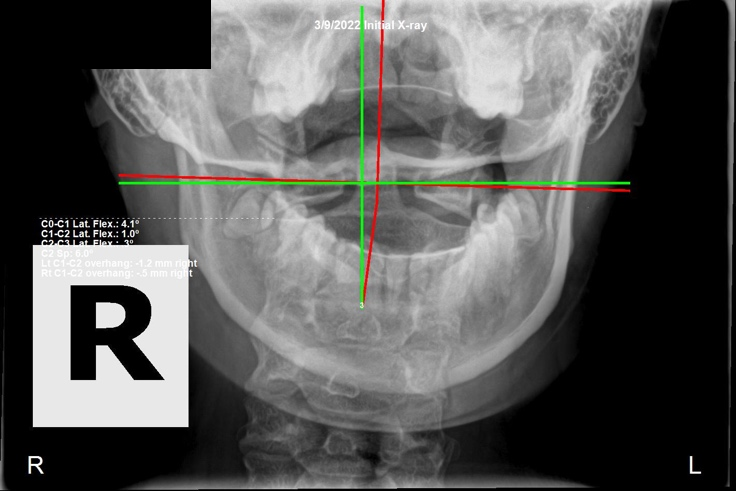 March 9, 2022 initial AP cervical X-ray showing severe left head rotation and significant Atlas C1 subluxation in a 27-year-old female, Rochet Family Chiropractic Royal Palm Beach