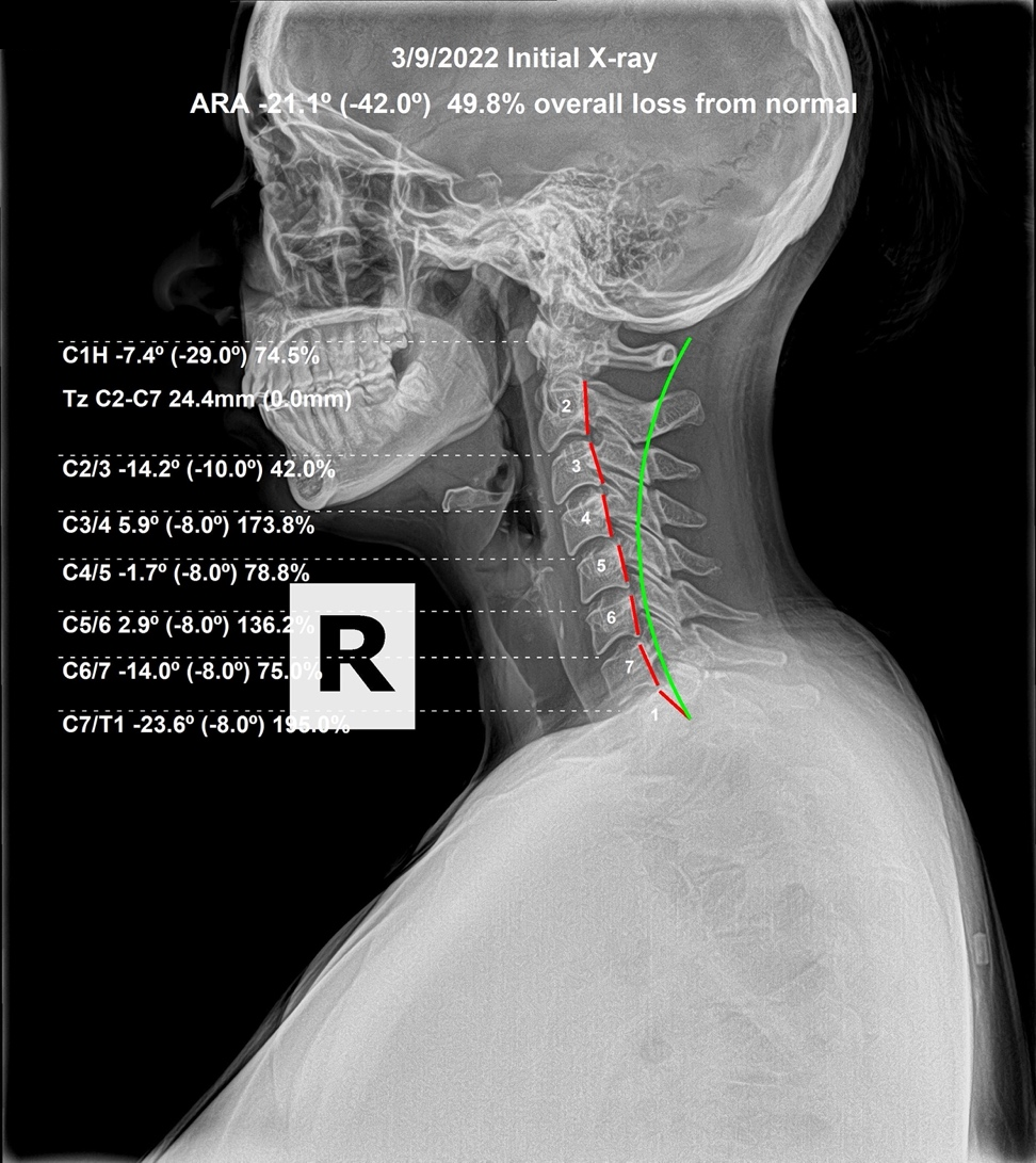 March 9, 2022 initial lateral cervical X-ray showing anterior head carriage and loss of cervical lordosis from long hours at a computer, Rochet Family Chiropractic Royal Palm Beach