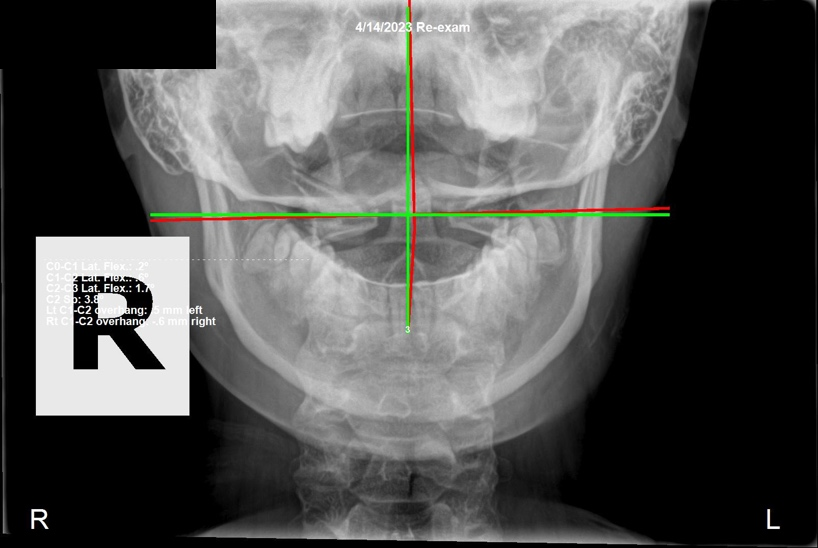 April 14, 2023 re-evaluation AP cervical X-ray showing the Atlas position and head rotation corrected, Rochet Family Chiropractic Royal Palm Beach