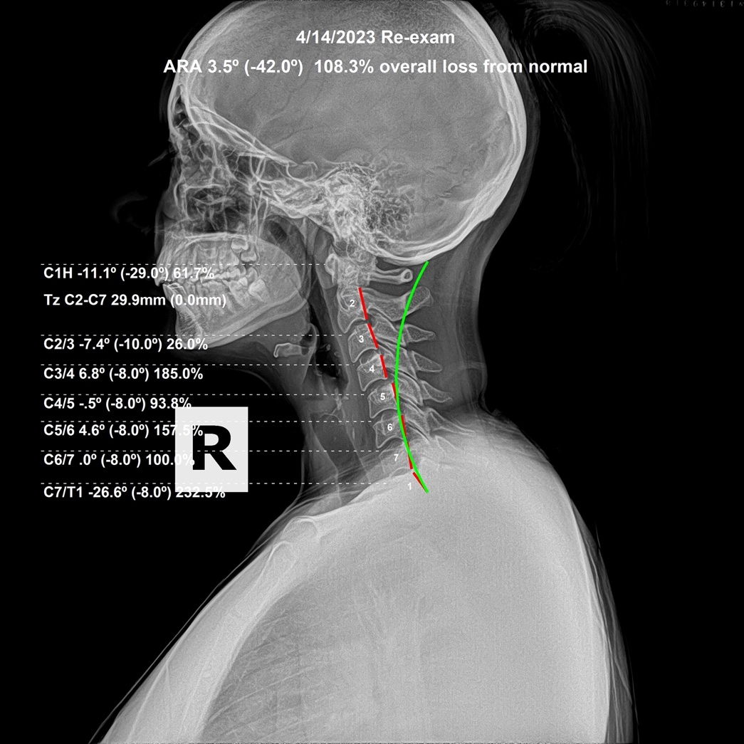 April 14, 2023 re-evaluation lateral cervical X-ray showing the cervical curve measured worse while Atlas position corrected, Rochet Family Chiropractic Royal Palm Beach