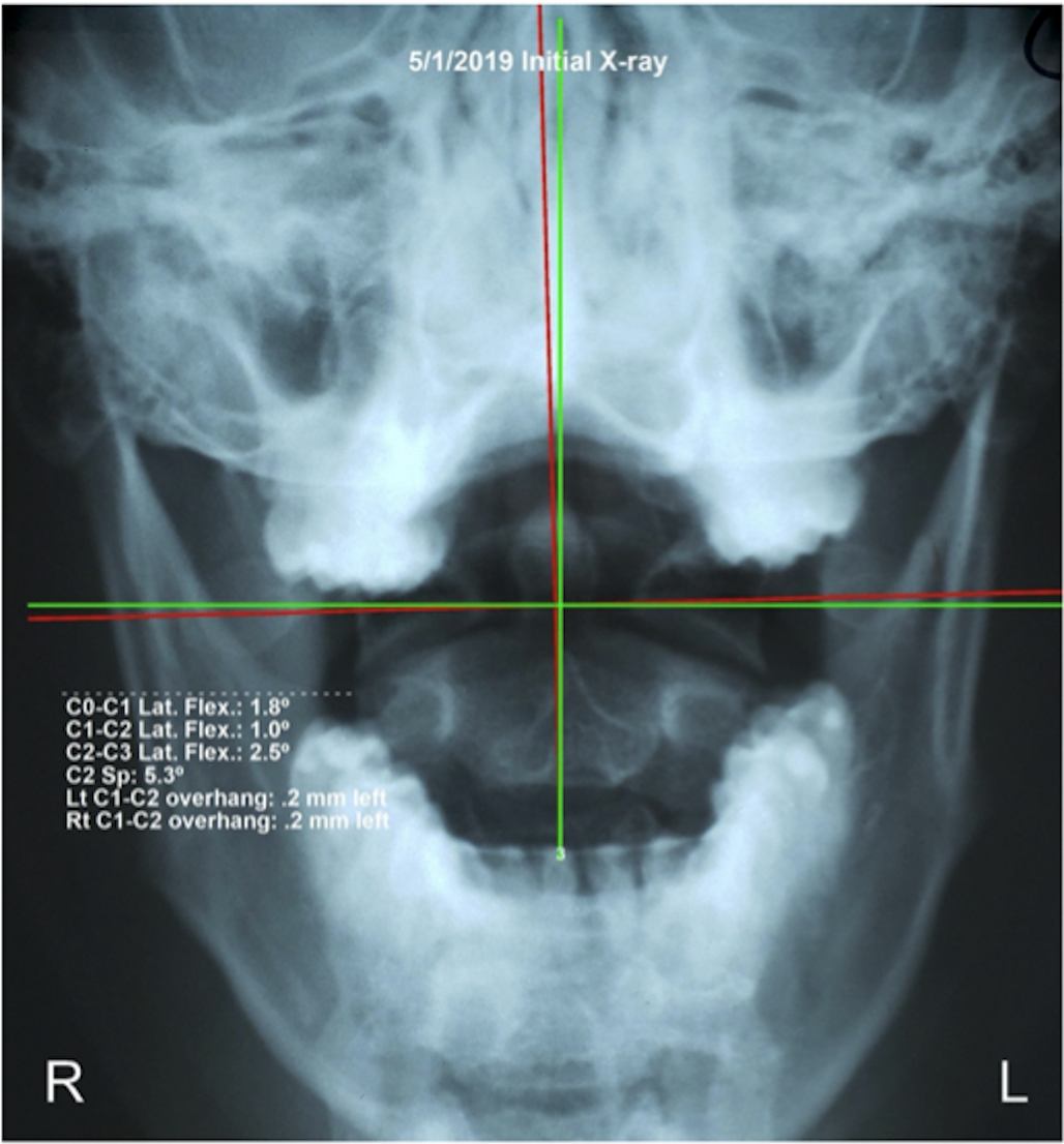 Initial AP upper cervical X-ray May 1 2019 — upper cervical subluxation, atlas misalignment, Rochet Family Chiropractic Royal Palm Beach