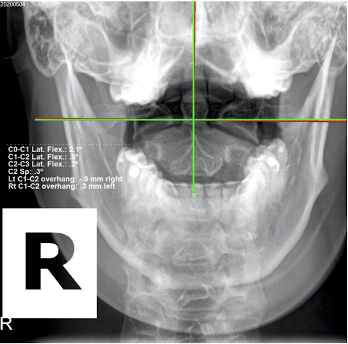 Re-evaluation AP upper cervical X-ray — improved atlas alignment after spinal structural correction, Rochet Family Chiropractic Royal Palm Beach