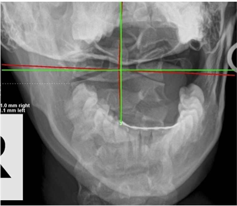 Initial AP upper cervical X-ray showing severe atlas C1 subluxation with 0.8mm right and 1.0mm left overhang in 23-year-old female with migraines and systemic dysfunction, Rochet Family Chiropractic Royal Palm Beach