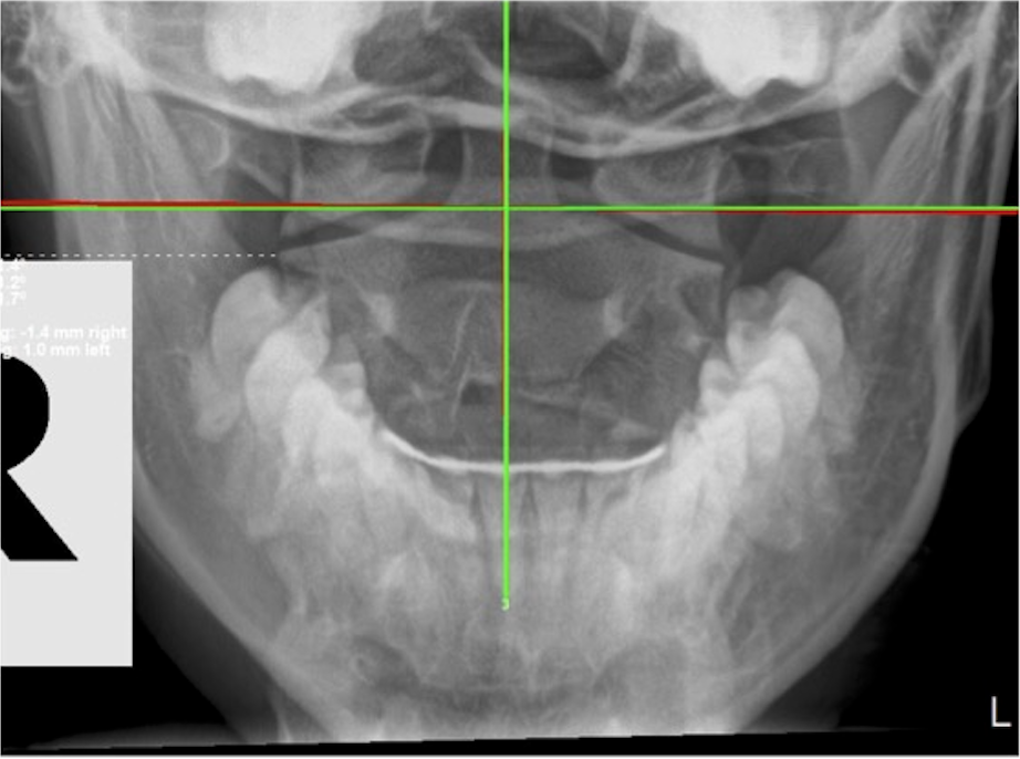 Re-evaluation AP upper cervical X-ray showing improved atlas alignment after corrective chiropractic care, headaches resolved, digestion improved, menstrual cycle regulated, Rochet Family Chiropractic Royal Palm Beach