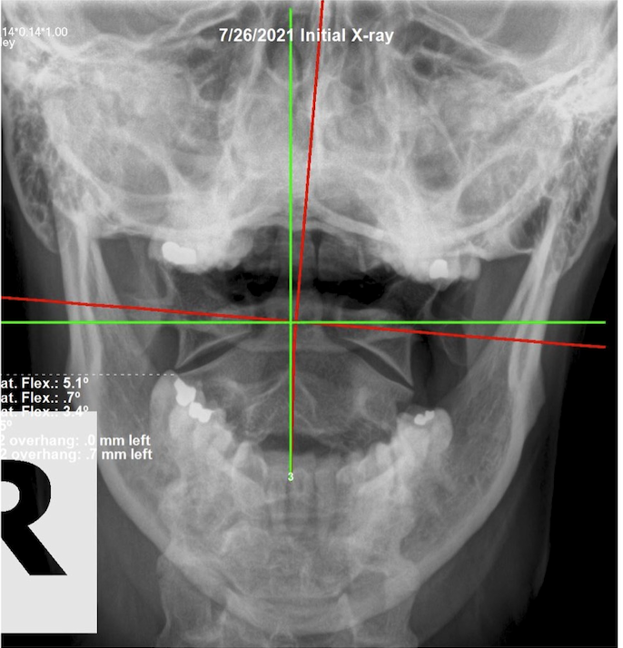 July 26, 2021 initial APOM open-mouth upper cervical X-ray of a 46-year-old female showing Atlas subluxation and head tilt, Rochet Family Chiropractic Royal Palm Beach