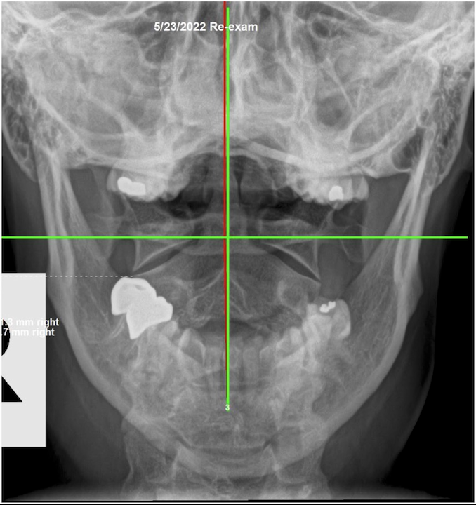May 23, 2022 re-evaluation APOM open-mouth upper cervical X-ray showing improved Atlas alignment and level head position after subluxation-based corrective care, Rochet Family Chiropractic Royal Palm Beach