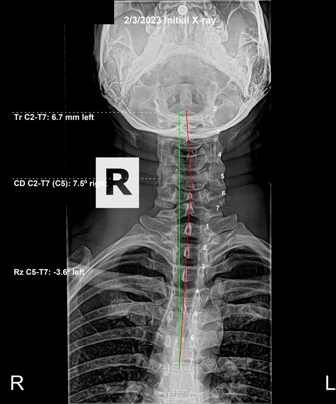 February 3, 2023 initial AP cervical X-ray showing a severe C5 subluxation to the left in a 38-year-old male, Rochet Family Chiropractic Royal Palm Beach