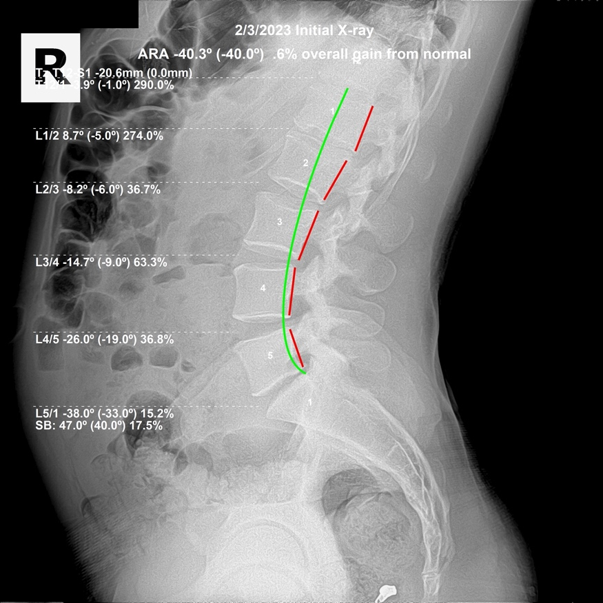 February 3, 2023 initial lateral lumbar X-ray showing an L1 L2 flexion subluxation with compensating increased curvature from L3 to L5, Rochet Family Chiropractic Royal Palm Beach