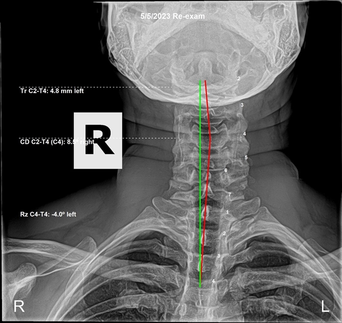 May 5, 2023 re-evaluation AP cervical X-ray showing C4 C5 corrected with the head and neck returning toward midline, Rochet Family Chiropractic Royal Palm Beach