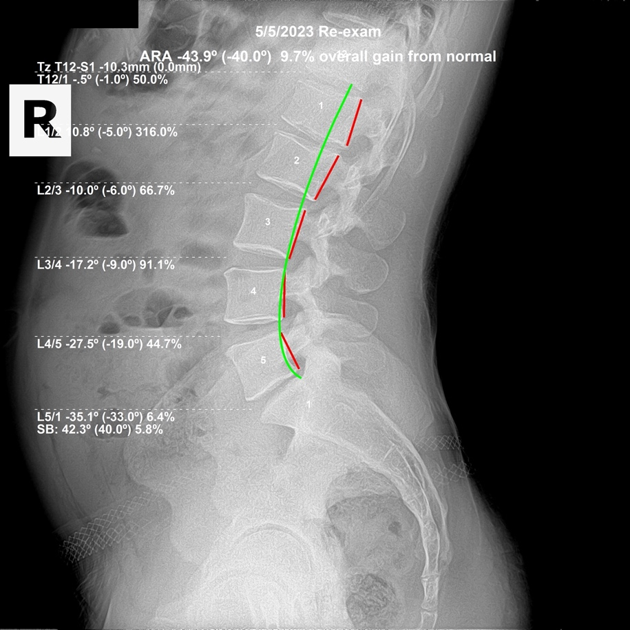 May 5, 2023 re-evaluation lateral lumbar X-ray showing restored ideal lordosis from L3 to L5 and reduced L1 L2 hyperflexion, Rochet Family Chiropractic Royal Palm Beach