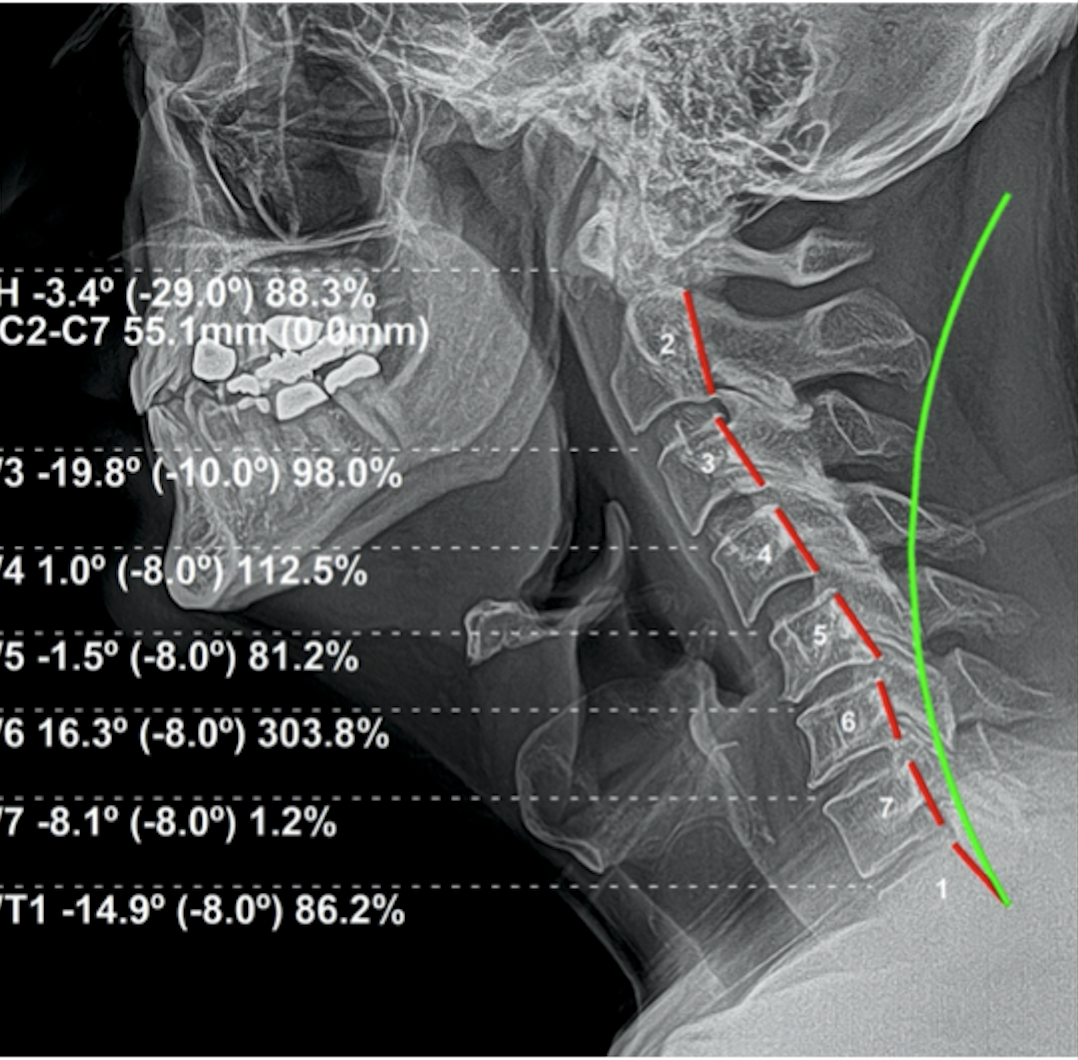 Initial lateral cervical X-ray — cervical subluxation with disc changes, reduced cervical curve, Rochet Family Chiropractic Royal Palm Beach