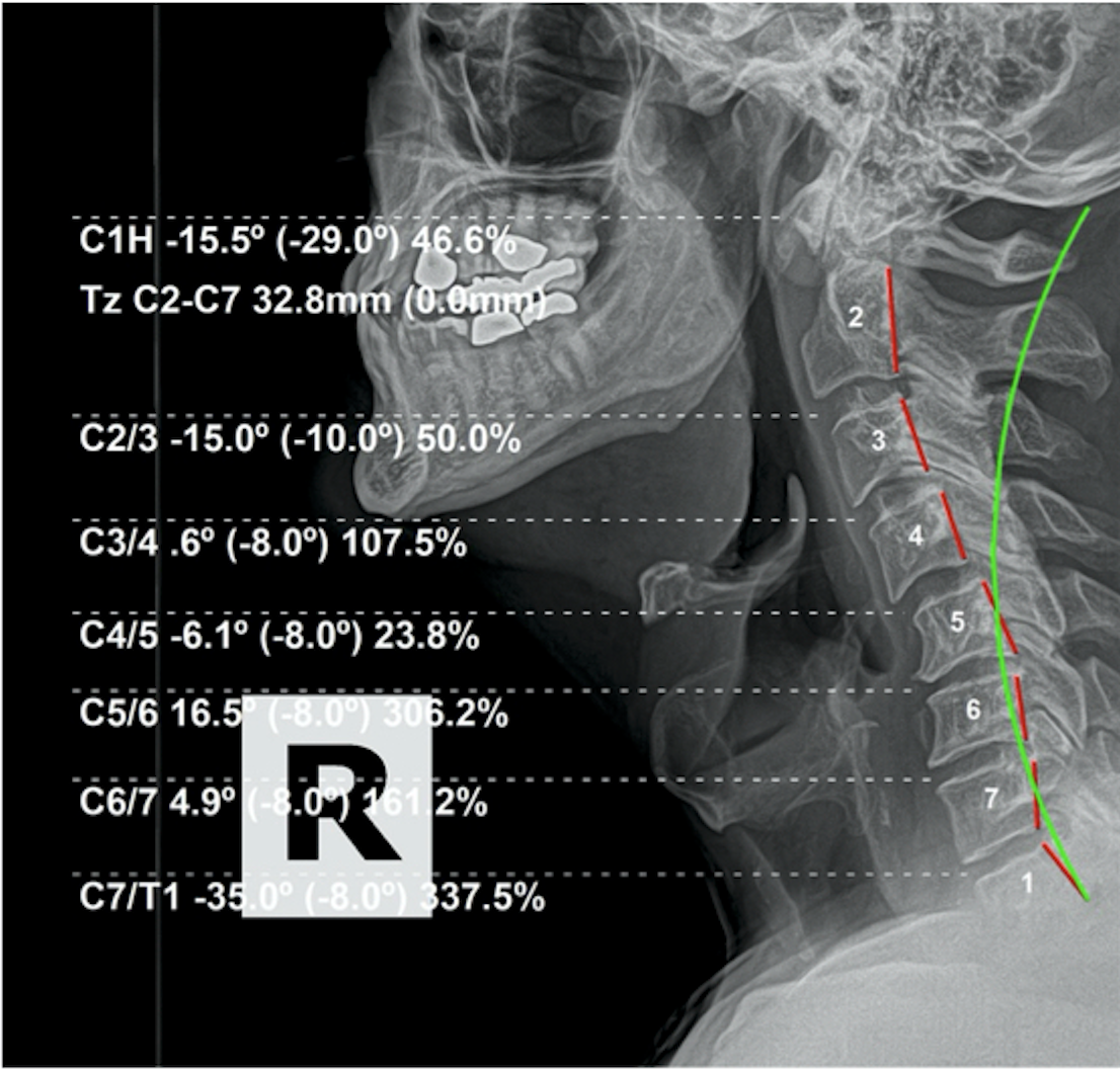 Re-evaluation lateral cervical X-ray — improved cervical alignment after 6-month spinal structural correction, Rochet Family Chiropractic Royal Palm Beach