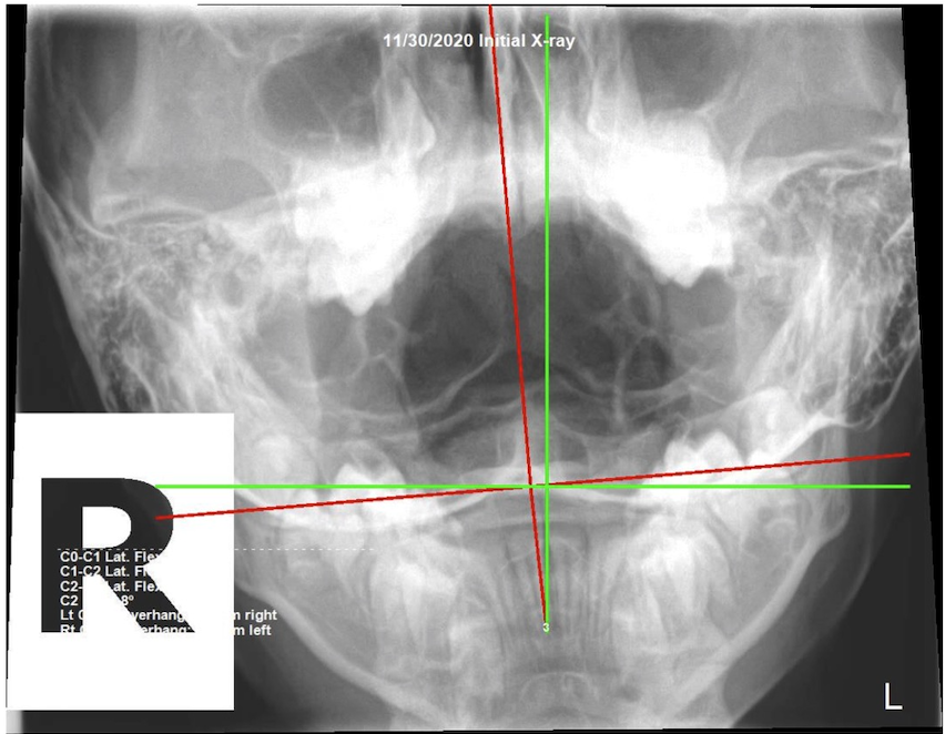 October 30, 2020 initial AP upper cervical X-ray showing severe atlas C1 subluxation in 10-year-old male with increasing facial tics, Rochet Family Chiropractic Royal Palm Beach