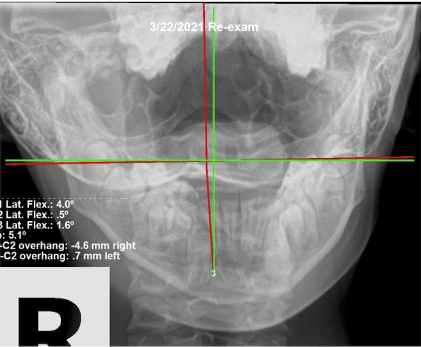 March 22, 2021 re-evaluation AP upper cervical X-ray showing improved C1 and C2 alignment after corrective care, facial tics resolved, Rochet Family Chiropractic Royal Palm Beach