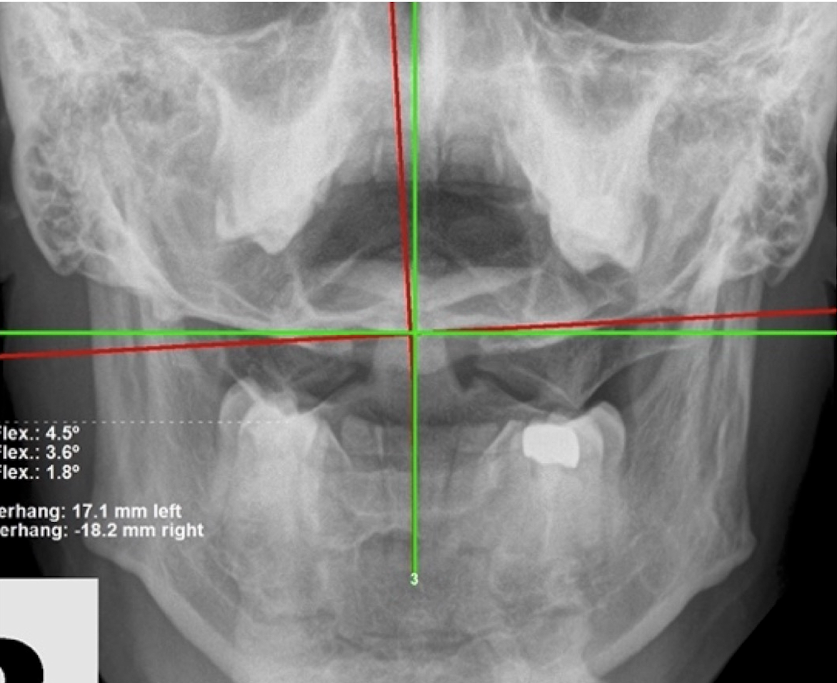 Initial APOM open-mouth upper cervical X-ray of a 47-year-old male veteran showing a large Atlas subluxation and 17.1mm lateral overhang, Rochet Family Chiropractic Royal Palm Beach