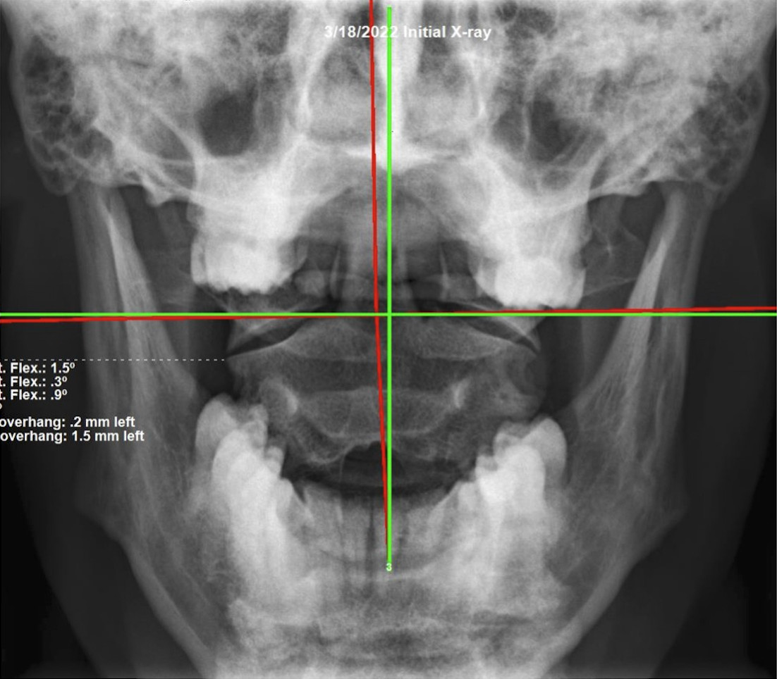 Re-evaluation APOM open-mouth upper cervical X-ray showing the Atlas overhang corrected to near neutral after three months of subluxation-based corrective care, Rochet Family Chiropractic Royal Palm Beach