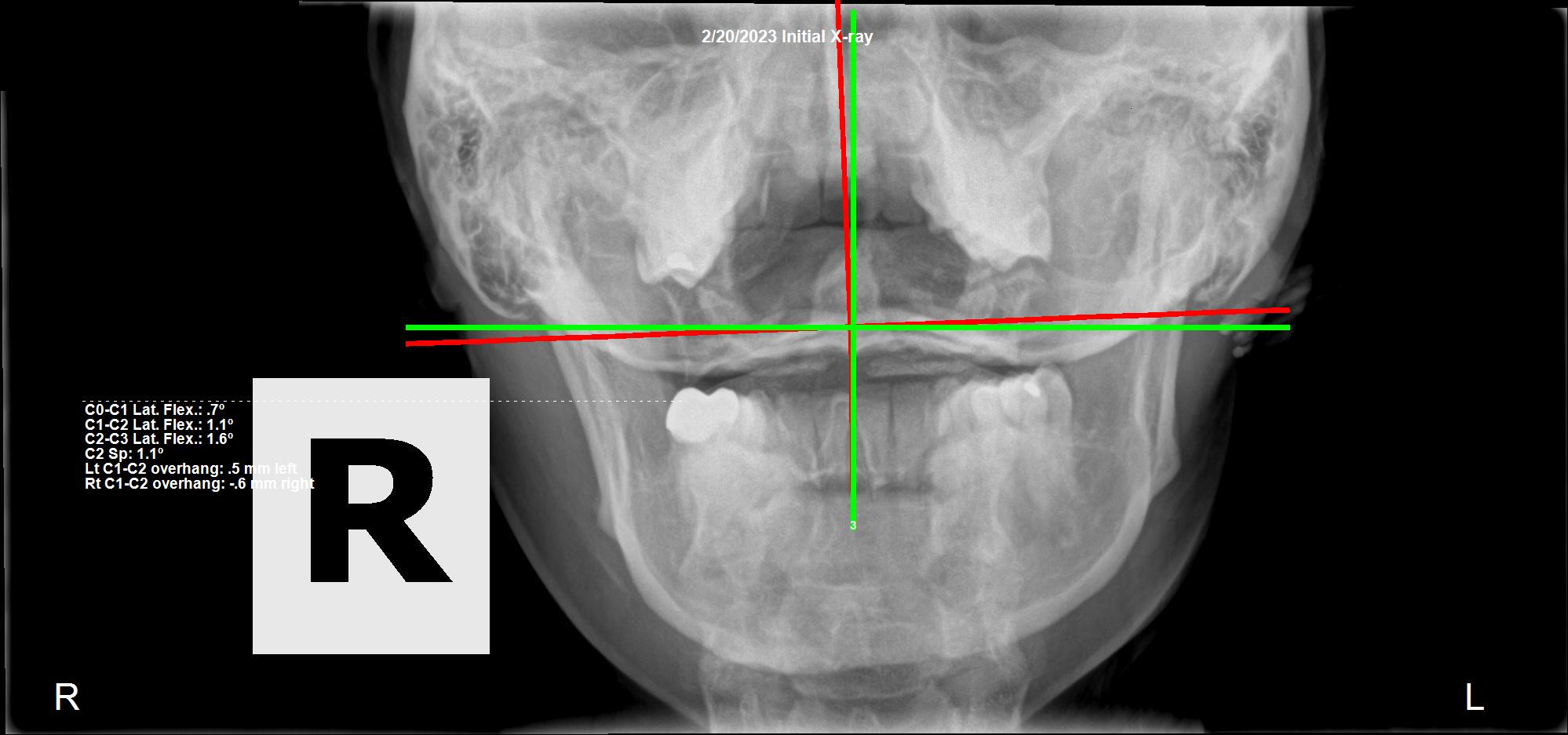 February 20, 2023 initial AP cervical X-ray showing an Atlas C1 subluxation in a 37-year-old female with frequent headaches, Rochet Family Chiropractic Royal Palm Beach
