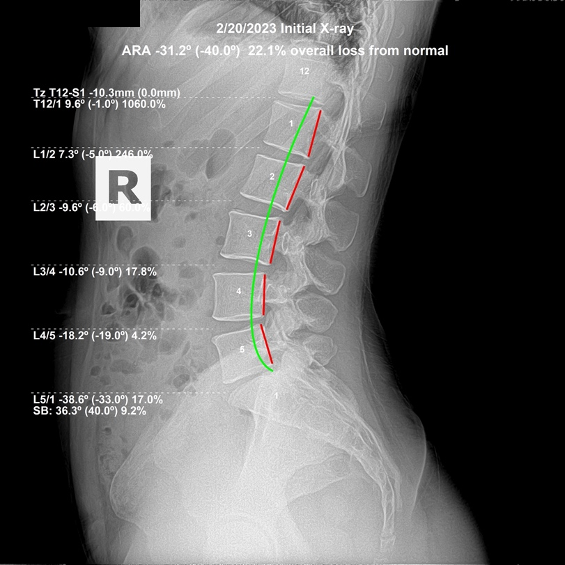 February 20, 2023 initial lateral lumbar X-ray showing an L1 L2 flexion subluxation contributing to low back pain and stiffness, Rochet Family Chiropractic Royal Palm Beach