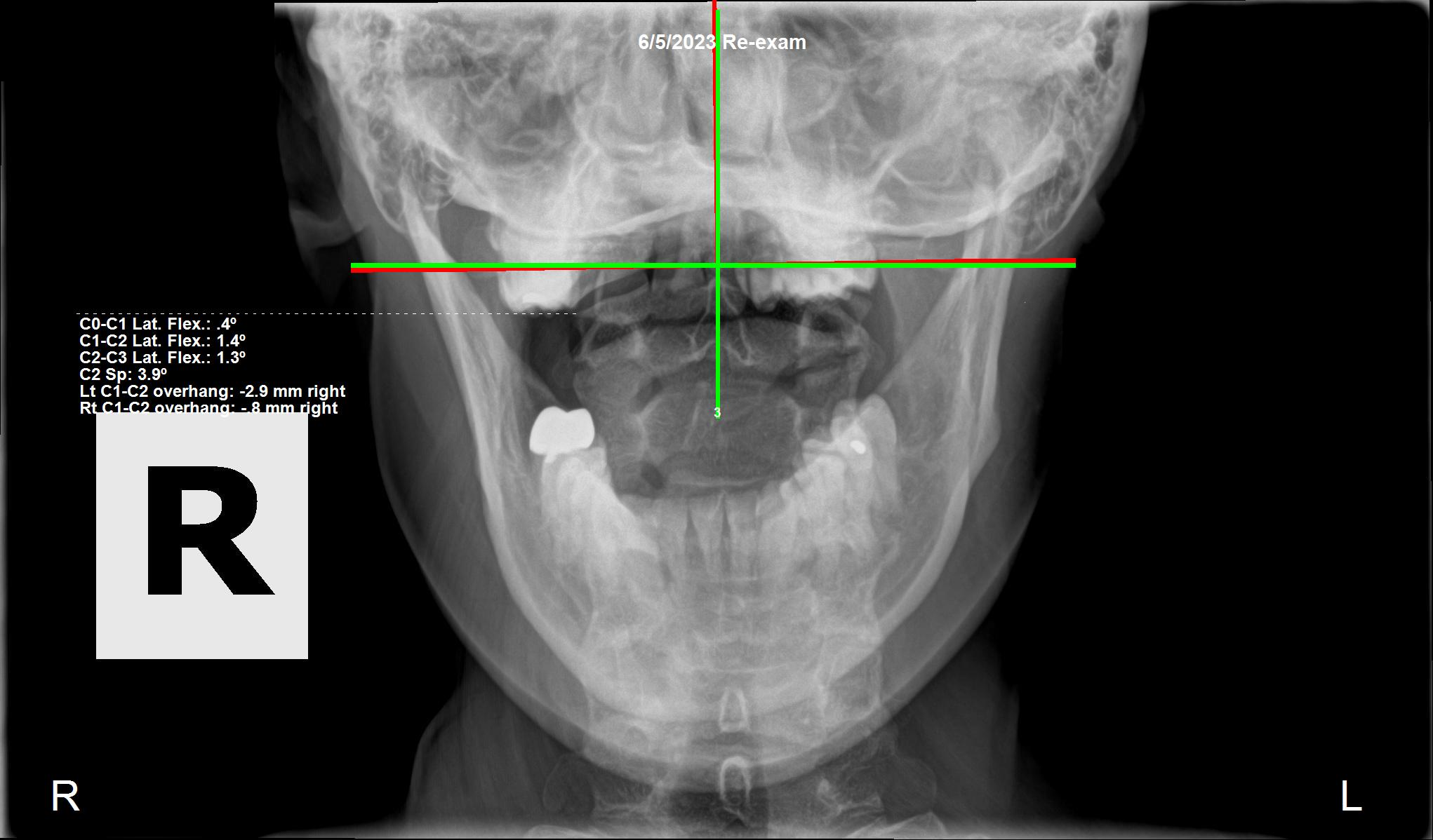 June 5, 2023 re-evaluation AP cervical X-ray showing C1 corrected after three months of subluxation-based care, Rochet Family Chiropractic Royal Palm Beach