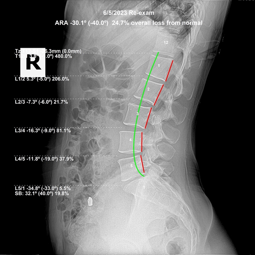 June 5, 2023 re-evaluation lateral lumbar X-ray showing improvement in the L1 L2 flexion subluxation, Rochet Family Chiropractic Royal Palm Beach