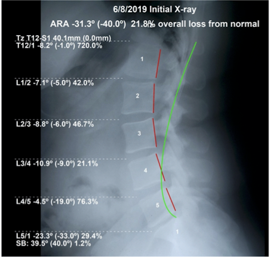 Initial lateral lumbar X-ray June 8 2019 — ARA -31.3 degrees, 21.8% overall loss from normal lumbar curve, Rochet Family Chiropractic Royal Palm Beach
