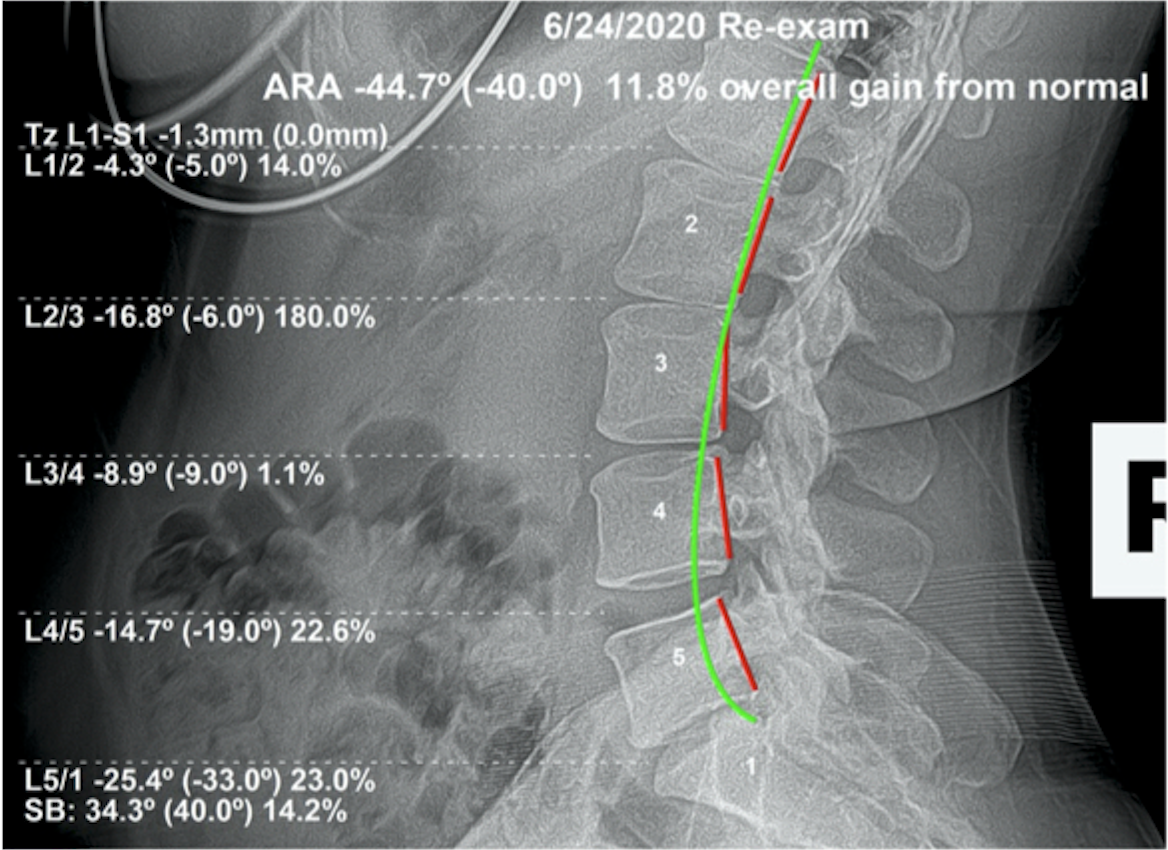 Re-evaluation lateral lumbar X-ray June 24 2020 — ARA -44.7 degrees, 11.8% gain from normal, exceeded target lumbar curve, Rochet Family Chiropractic Royal Palm Beach