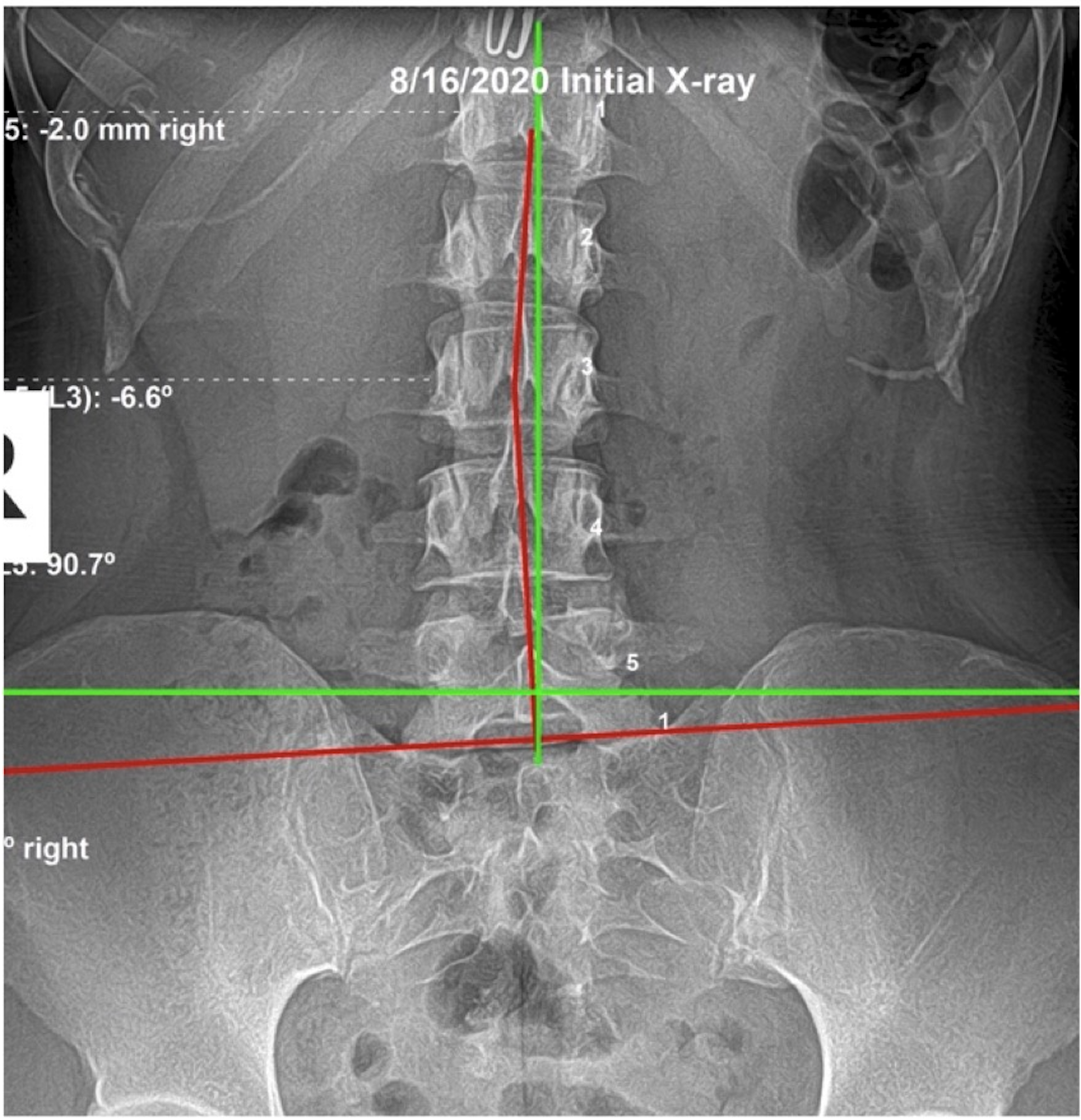 August 10, 2020 initial AP lumbar X-ray showing significant lumbar subluxation in 24-year-old female with prior leg and hip surgeries for congenital structural deformities, Rochet Family Chiropractic Royal Palm Beach