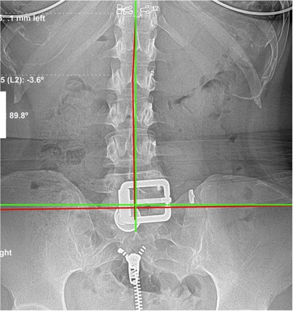 Re-evaluation AP lumbar X-ray showing near-perfect spinal correction after 9 months of subluxation-based corrective care despite complicating surgical history, Rochet Family Chiropractic Royal Palm Beach