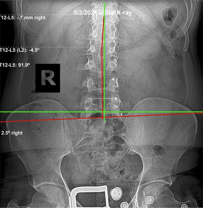 August 3, 2021 initial AP lumbar and pelvic X-ray of a 41-year-old male first-time chiropractic patient showing spinal subluxation and postural imbalance, Rochet Family Chiropractic Royal Palm Beach