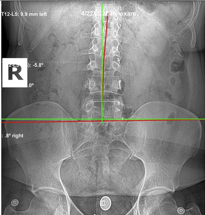 April 22, 2022 re-evaluation AP lumbar and pelvic X-ray showing improved postural balance after subluxation-based corrective care, Rochet Family Chiropractic Royal Palm Beach