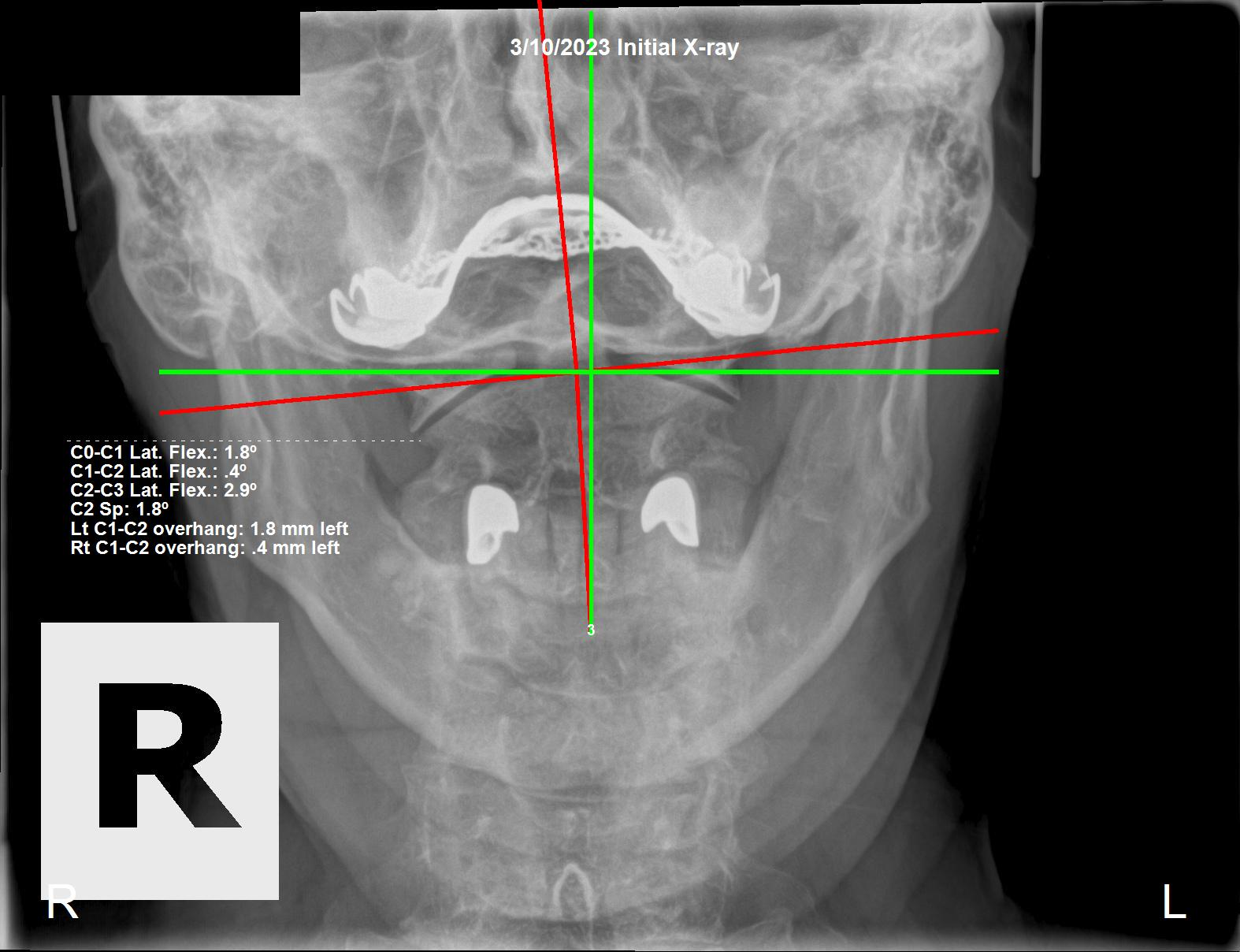 March 10, 2023 initial AP cervical X-ray showing a severe Atlas C1 subluxation in a 70-year-old male tradesman, Rochet Family Chiropractic Royal Palm Beach
