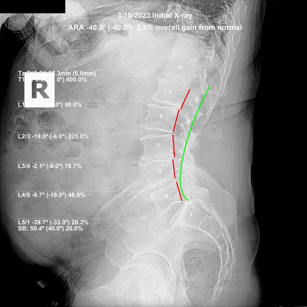 March 10, 2023 initial lateral lumbar X-ray showing multilevel disc degeneration, spondylosis and abnormal L3 positioning, Rochet Family Chiropractic Royal Palm Beach
